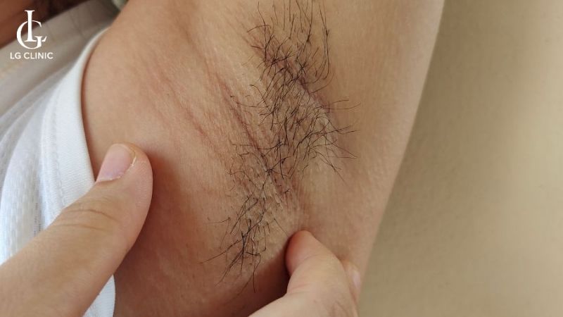 triệt lông nách bằng tia laser