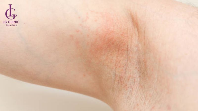 Triệt lông nách có ảnh hưởng gì không