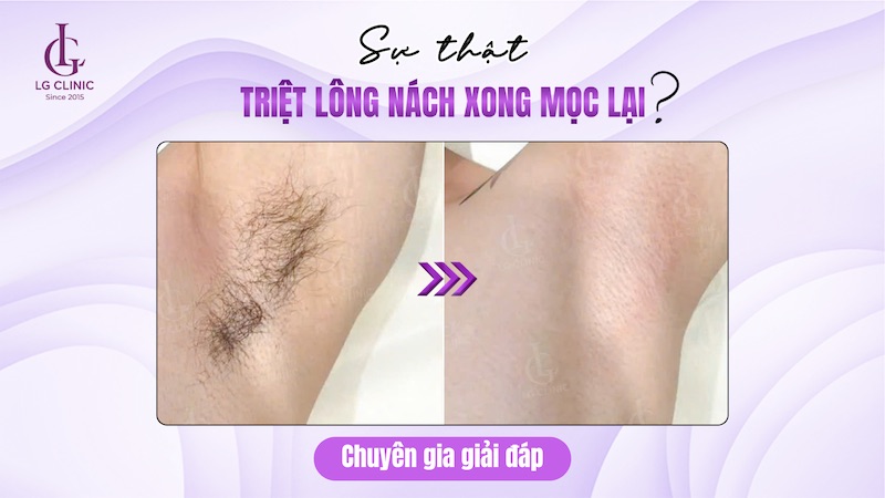 triệt lông nách có mọc lại không