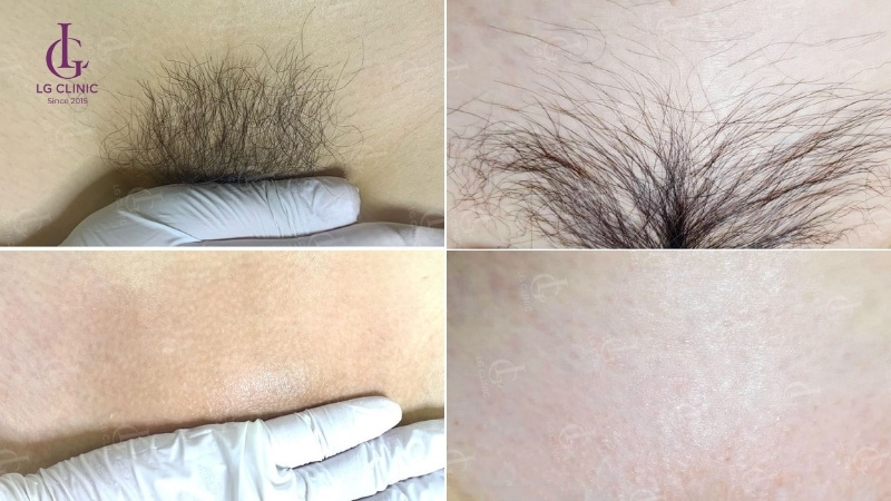 kết quả sau khi triệt lông vùng kín tại LG Clinic