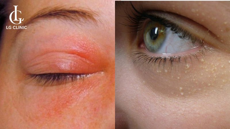 vitamin e có trị thâm mắt không