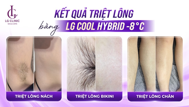 kết quả triệt lông lạnh