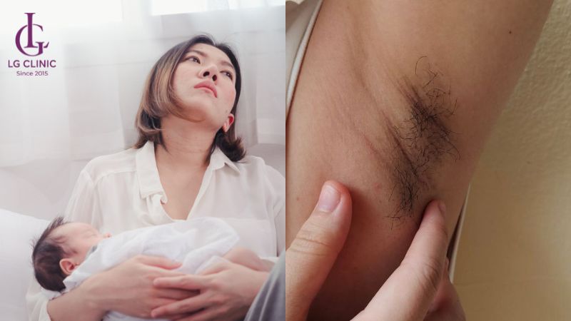 đang cho con bú có triệt lông nách được không