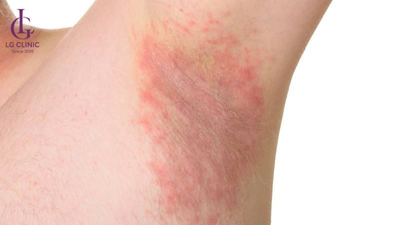 đang cho con bú có triệt lông nách được không