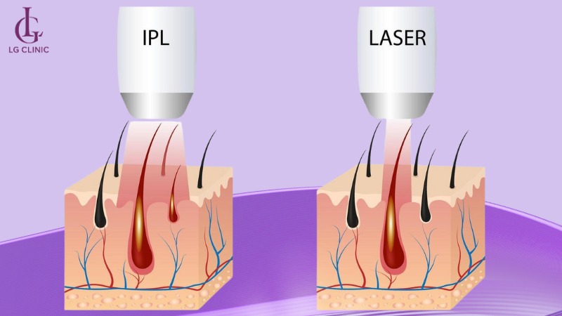 giá triệt lông nách