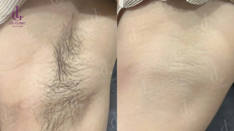 giá triệt lông nách