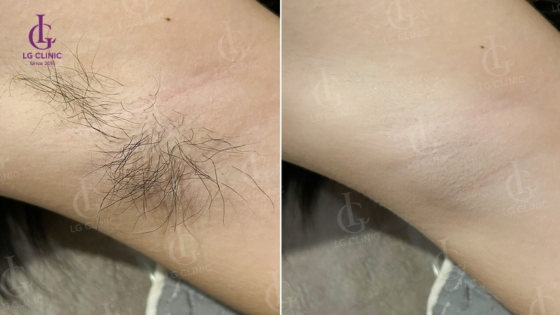 giá triệt lông nách