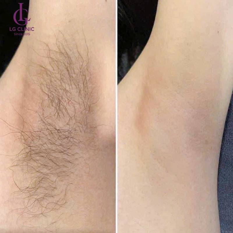 hình ảnh triệt lông nách