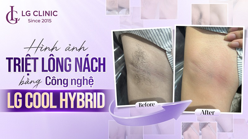 Hình ảnh triệt lông nách bằng công nghệ LG Cool Hybrid tại LG Clinic