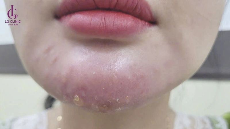 tiêm filler bị nhiễm trùng