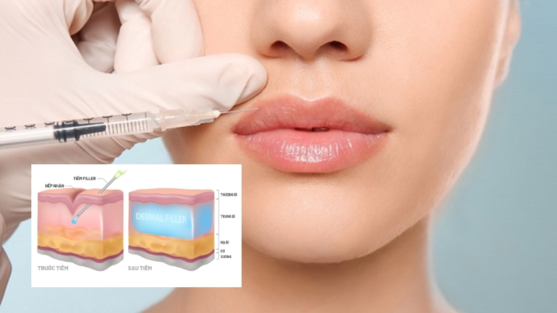 kỹ thuật tiêm filler môi