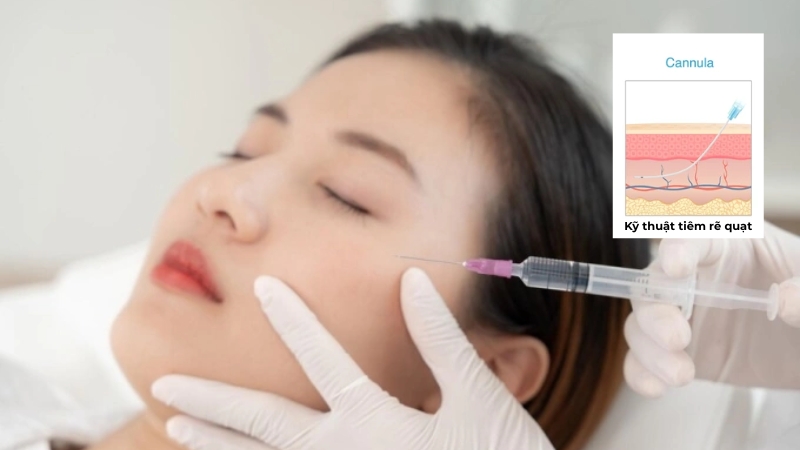 kỹ thuật tiêm filler má