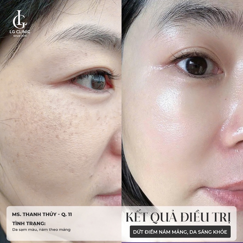 trị nám pico melasma