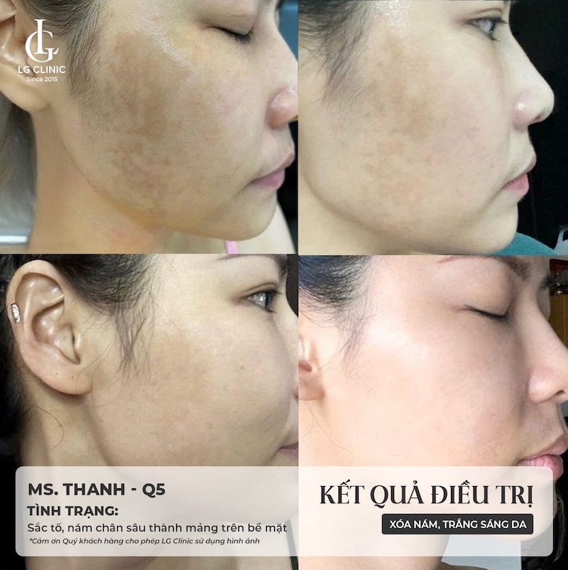 trị nám pico melasma