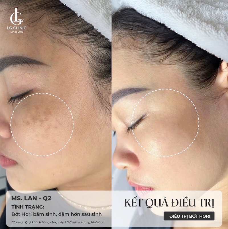 trị nám pico melasma