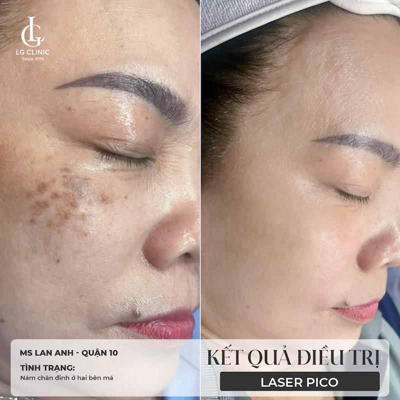 trị nám pico melasma