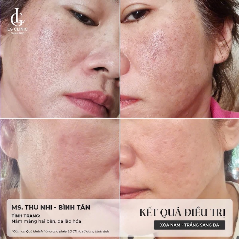 trị nám pico melasma
