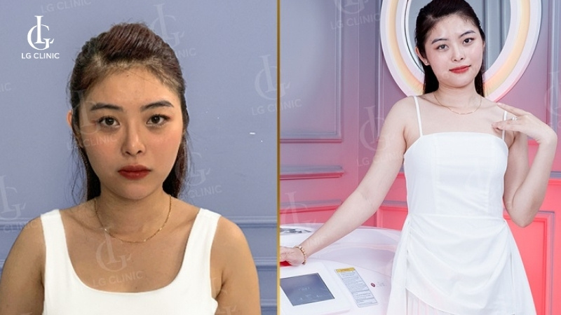 Tắm trắng có bị bắt nắng không