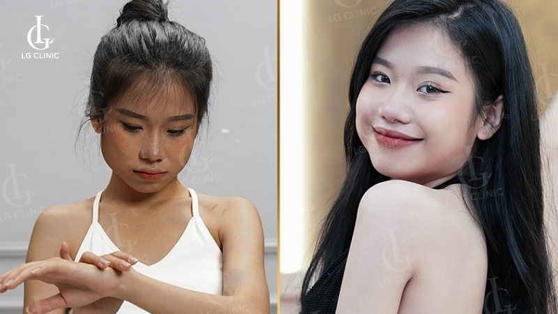 Tắm trắng có bị bắt nắng không