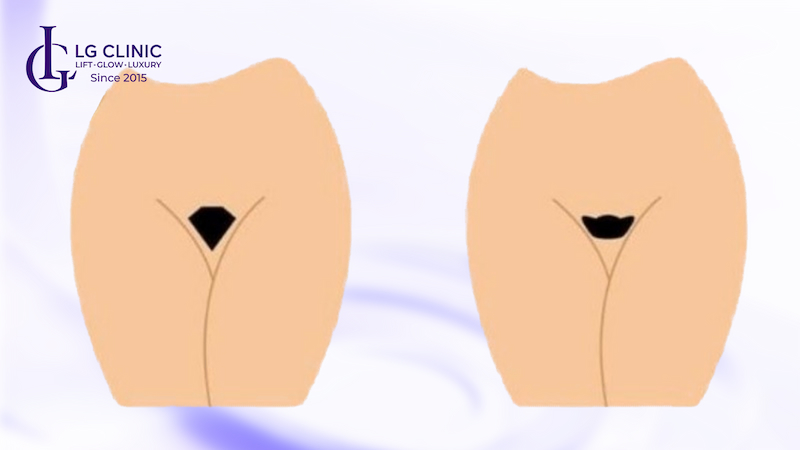 triệt lông bikini phong thủy