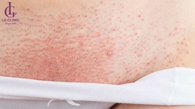 vùng kín bị kích ứng