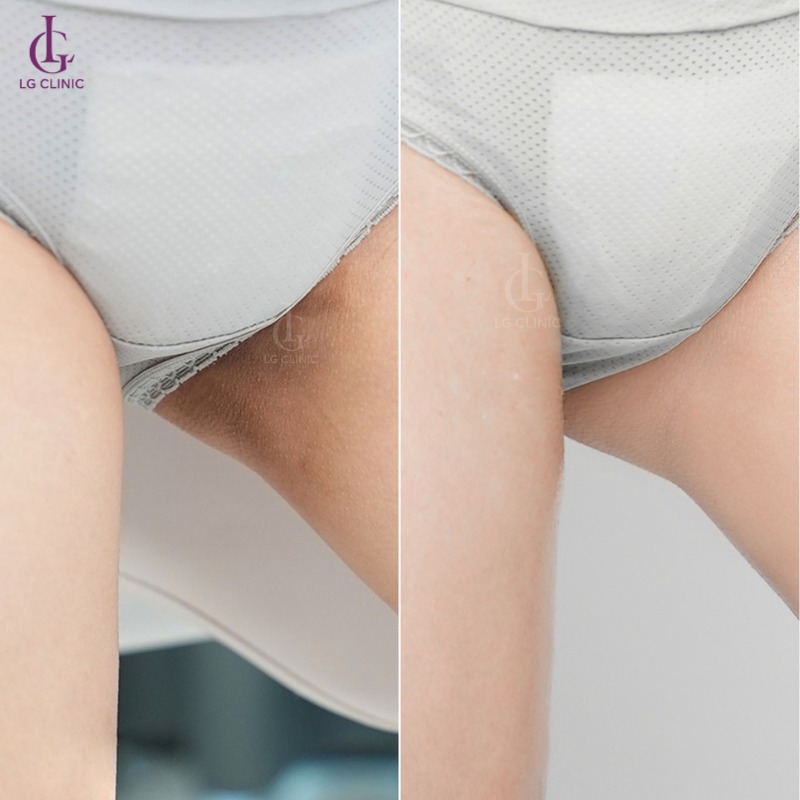 thâm bẹn sau sinh có tự hết không