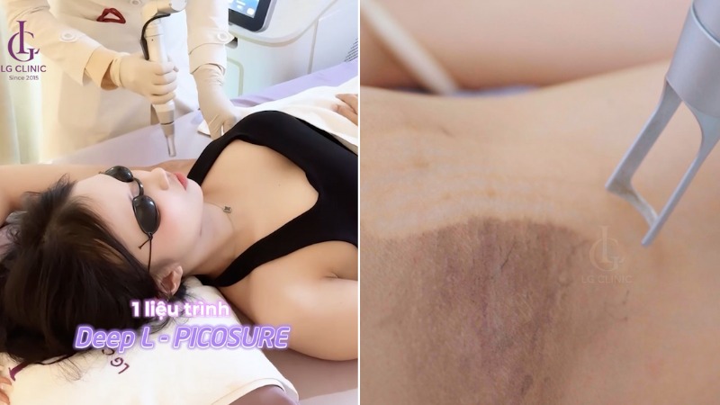 thâm nách sau sinh có tự hết không