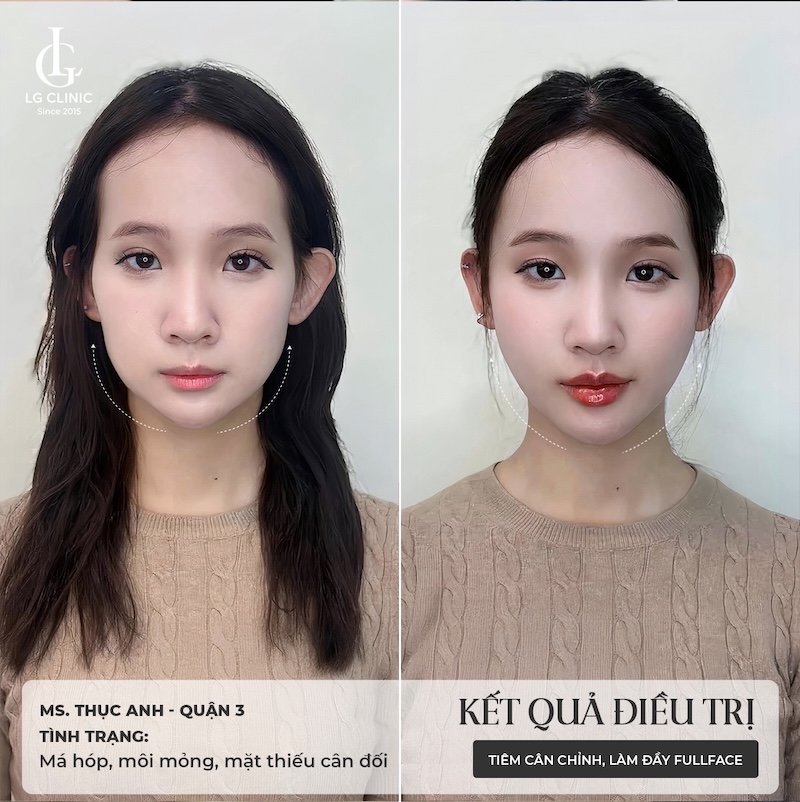 tiêm filler tại lg clinic