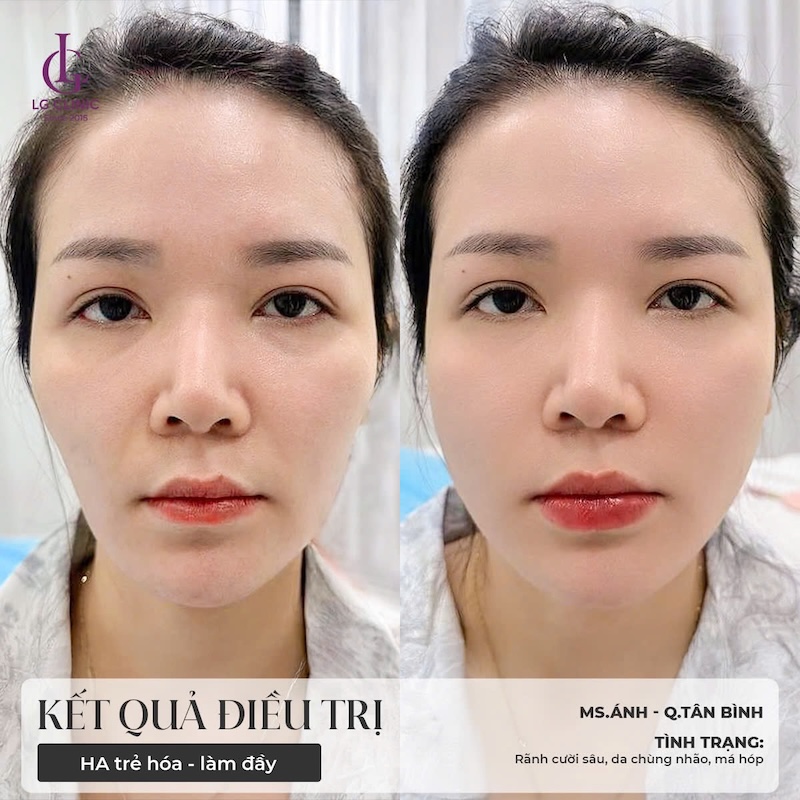 tiêm filler tại lg clinic