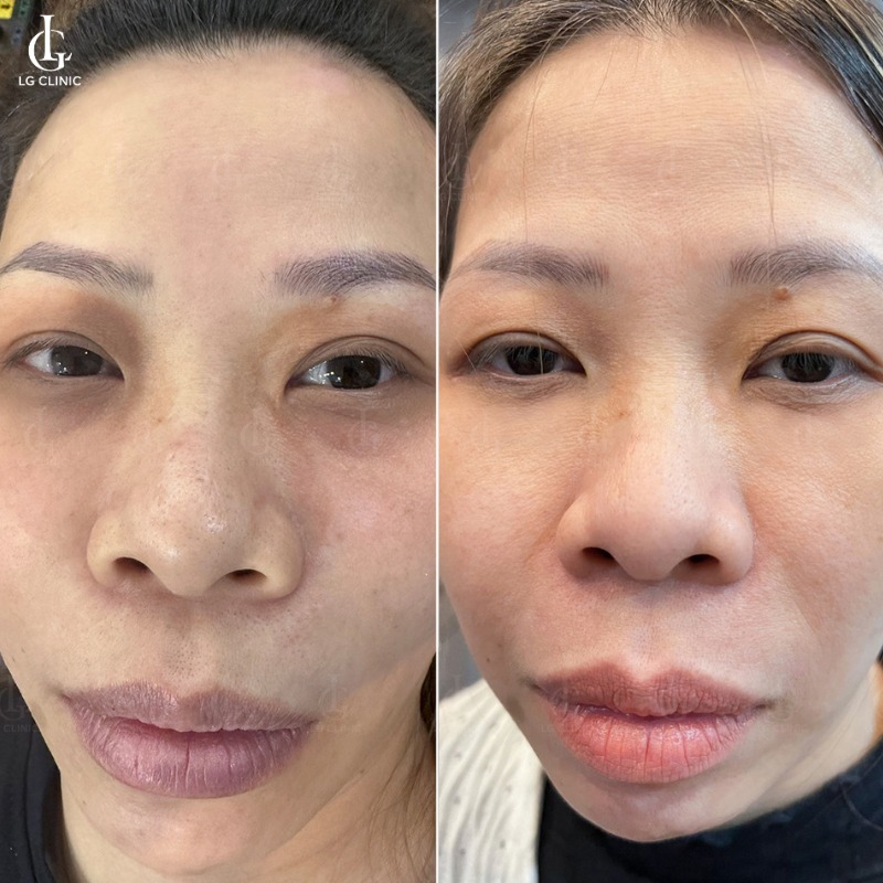 trị thâm mắt bằng bã cà phê - trị thâm mắt bằng laser