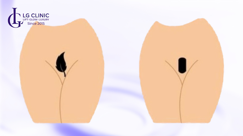 triệt lông bikini phong thủy mệnh thủy