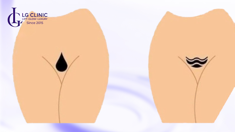 triệt lông bikini phong thủy