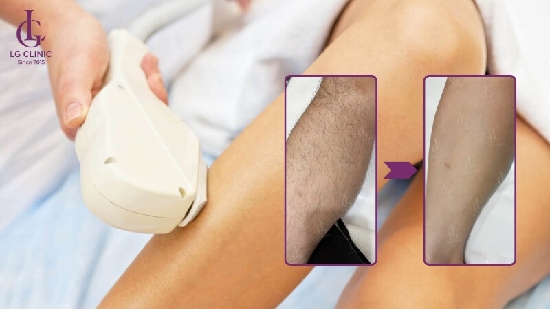 triệt lông nam giới giúp giảm viêm nang lông