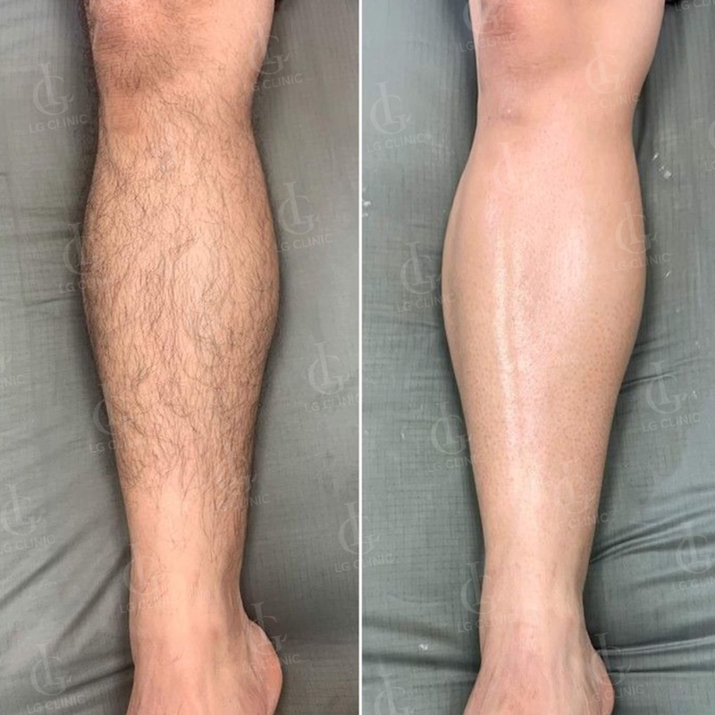 Kết quả triệt lông chân cho nam