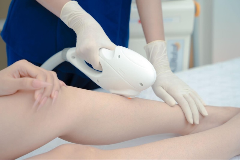 giá triệt lông chân tùy thuộc vào cơ sở