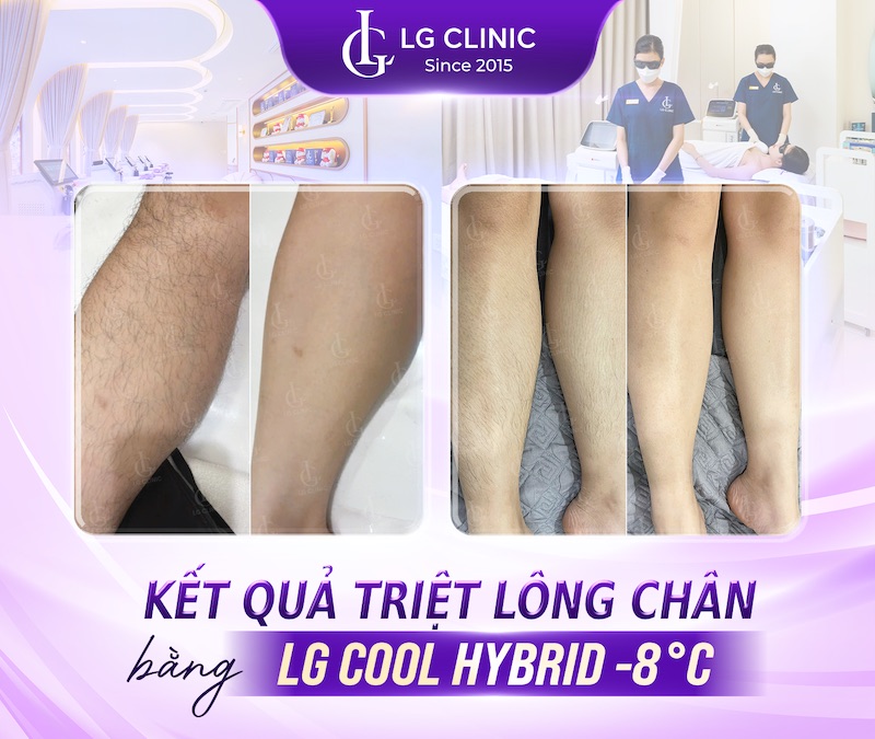 kết quả triệt lông chân