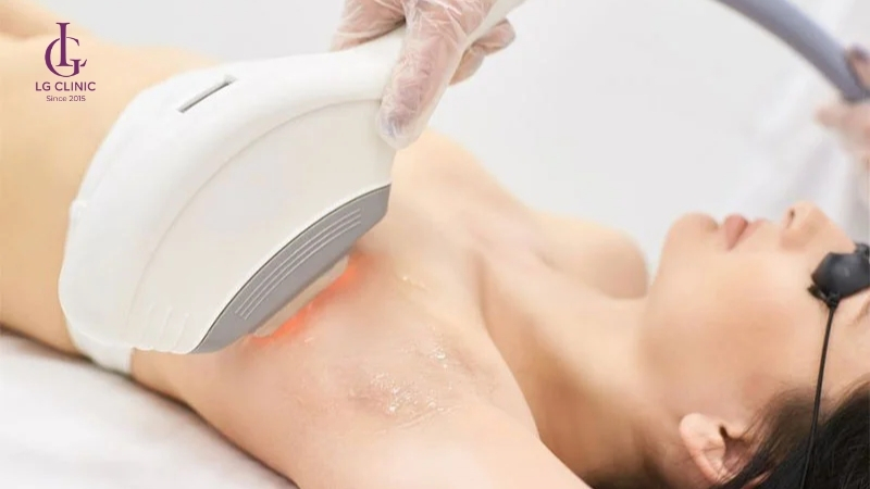 Triệt lông nách bao nhiêu phút