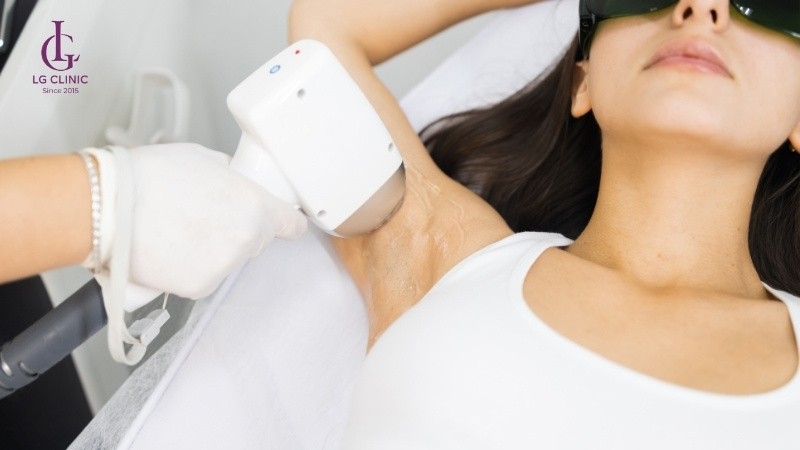 Triệt lông nách bao nhiêu phút