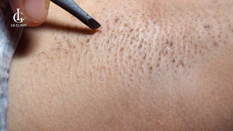 Triệt lông nách có được nhổ không