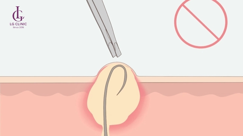 Triệt lông nách có được nhổ không