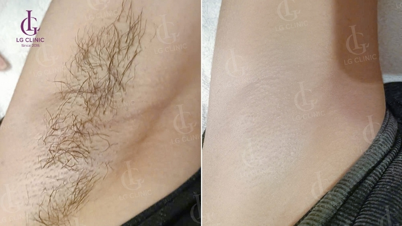 Triệt lông nách có được nhổ không