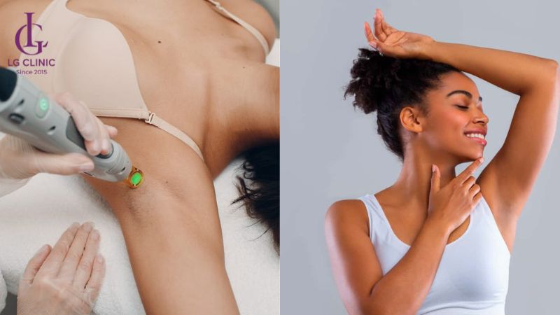 triệt lông nách có giảm mồ hôi không