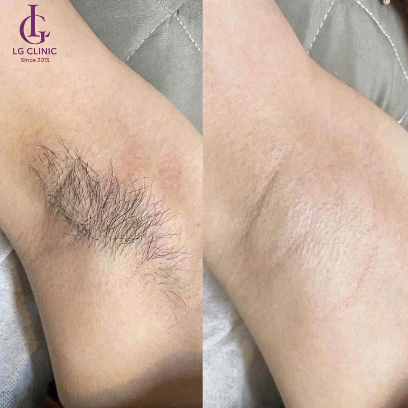 triệt lông nách có giảm mồ hôi không