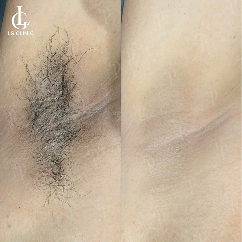 triệt lông nách nam