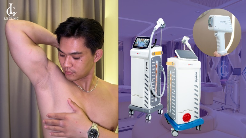 triệt lông nách nam