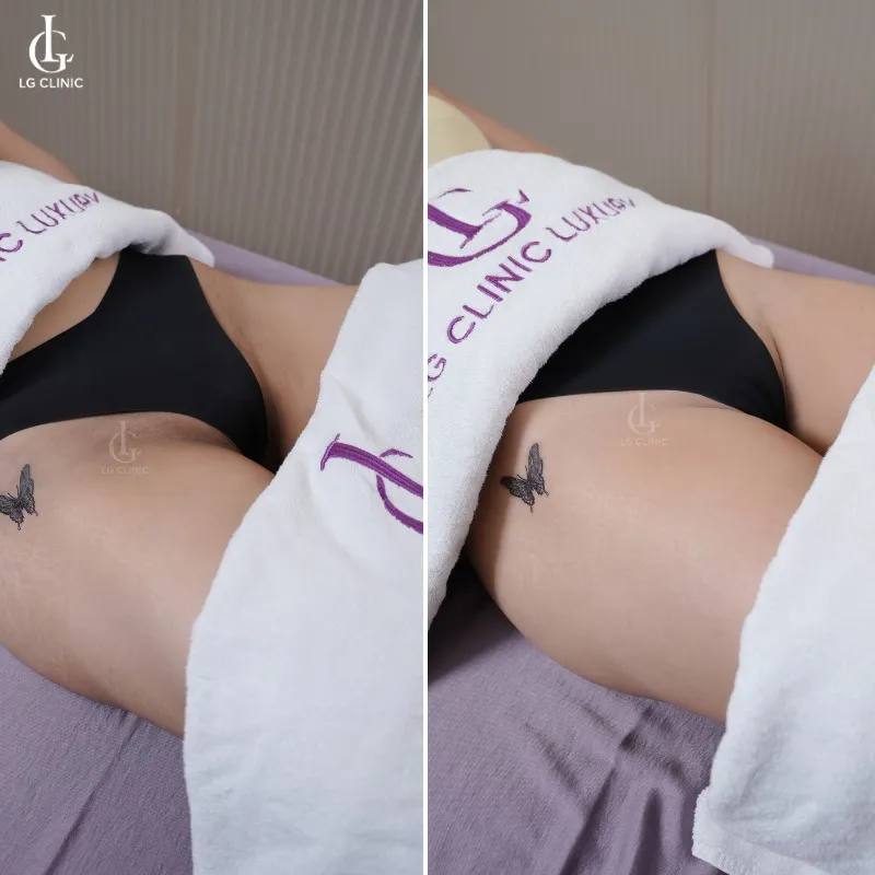 Hình ảnh trị thâm bẹn