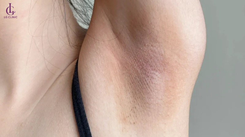 nách bị thâm đen là bệnh gì