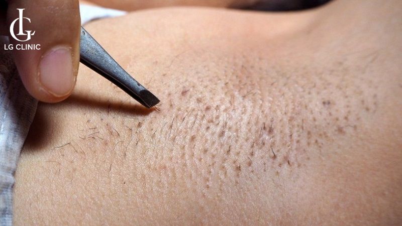 nhổ lông nách có bị hôi nách không