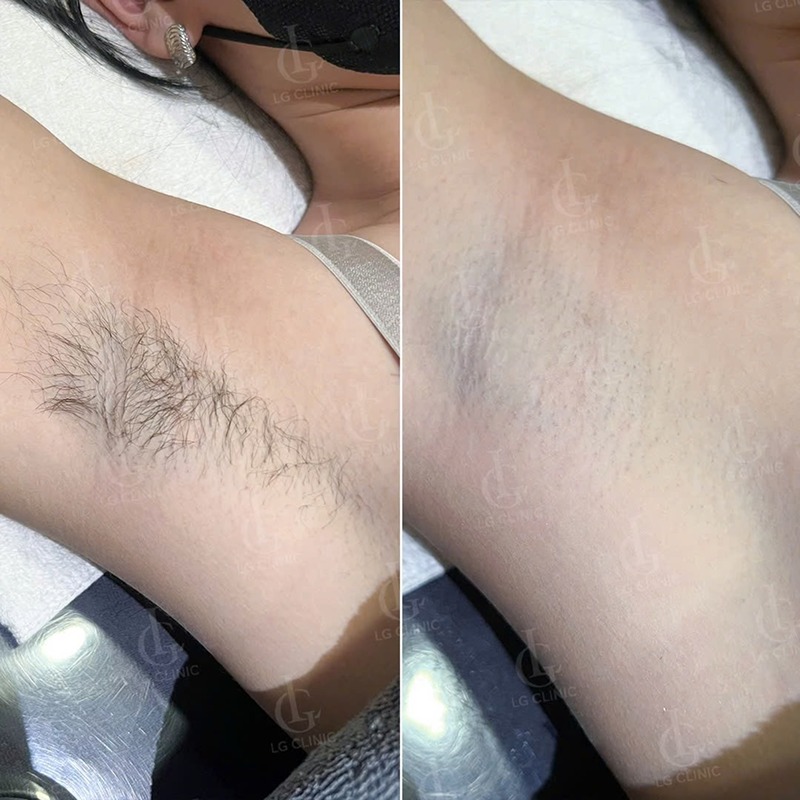 nhổ lông nách có bị hôi nách không