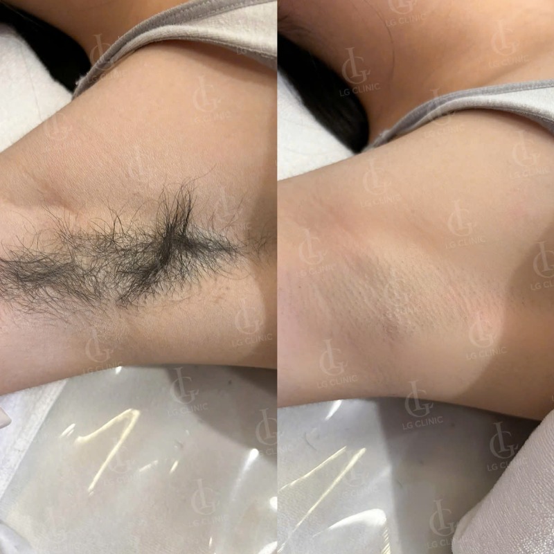 nhổ lông nách có bị hôi nách không